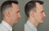 35-44 year old man treated with Chin Surgery and Rhinoplasty