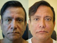 55-64 year old man treated with Liquid Facelift