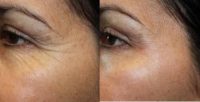 55-64 year old woman treated with Botox