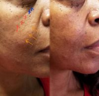 45-54 year old woman treated with Non Surgical Face Lift