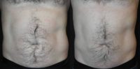 45-54 year old man treated with Emsculpt