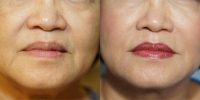 65-74 year old woman treated with Juvederm Ultra Plus