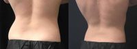 25-34 year old man treated with CoolSculpting