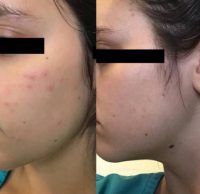 18-24 year old woman treated with Acne Treatment