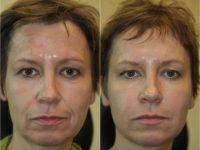 35-44 year old woman treated with Juvederm and Botox