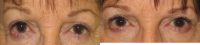 65-74 year old woman treated with blepharoplasty and internal ptosis repair
