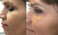 45-54 year old woman treated with Botox