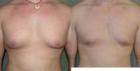 18 year old man treated with VASER ultrasound assisted liposuction