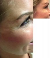 18-24 year old woman treated with Botox