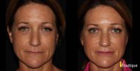 35-44 year old woman treated with Restylane & Dysport