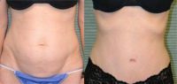 32 year old woman treated with Tummy Tuck