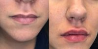 25-34 year old woman treated with Juvederm for lips