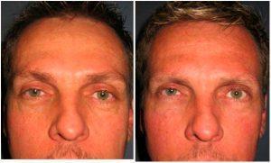 0.4cc Of Restylane In Each Lid-cheek Junction By Robert Cohen, MD, Plastic Surgeon In Paradise Valley, Arizona