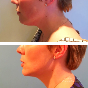 1 Kybella Treatment Before And After By JENNIFER CANESI, APN-BC, Board Certified Adult Nurse Practitioner In Boston