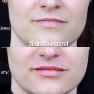 1 ML Of Restylane Refyne To Enhance The Lips By Dr. Shaun Patel, MD, Coral Gables FL Physician