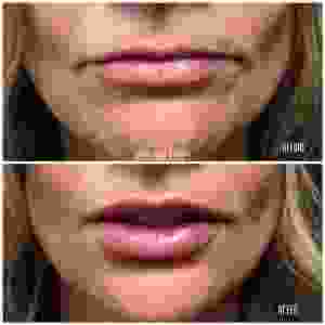 1 Syringe Of Juvederm Ultra XC And 1 Syringe Of Volbella In The White And Pink Lip By Scottsdale Plastic Surgeon, Dr. John J. Corey, MD