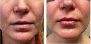 1 Syringe Of Juvederm Ultra XC To Add Subtle Volume To The Pink Lip By Scottsdale Plastic Surgeon, Dr. John J. Corey, MD