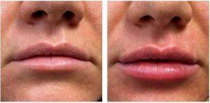 1 Syringe Of Juvederm XC To Give Lips More Symmetry And Fullness By Scottsdale Plastic Surgeon, Dr. John J. Corey, MD (1)