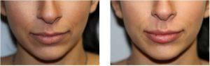 1 Syringe Of Restylane Silk To Create Fuller, Youthful Lips By Dr. Surjit Rai, Plastic Surgeon In Dallas, Texas