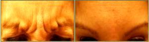 11 Frown Lines Botox Treatment By Dr. Tricia Brown, Dermatologist In Houston, TX