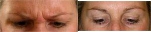 11 Lines Before And After At Always Beautiful Medspa, Medical Spa In Aurora, Colorado