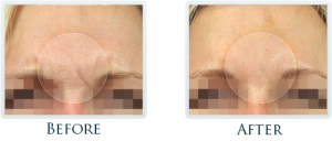 11 Lines Before And After At Thrive Aesthetic & Anti Aging Center
