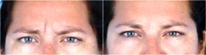 11 lines Botox Before And After By Dr. Steven H. Dayan, MD, Doctor in Chicago, Illinois