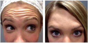 12 Units Of Botox To Her Forehead (frontalis Muscle) By Scottsdale Plastic Surgeon, Dr. John J. Corey, MD