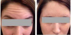 18 Year Old Woman Treated With Botox With Dr Edward Fruitman, MD, New York Physician