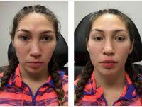 18 Year Old Woman Treated With Juvederm By Dr Justin Harper, MD, Columbus Physician