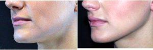 18 Year Old Woman Treated With Restylane With Dr. Landon Pryor, MD, FACS, Rockford Plastic Surgeon