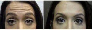 19 Year Old Woman Treated With Botox Before And After With Dr. Peter Chang, MD, Houston Plastic Surgeon
