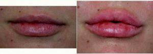 19 Year Old Woman Treated With Juvederm Before & After With Dr Alan N. Larsen, MD, Atlanta Plastic Surgeon
