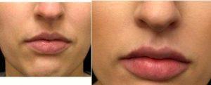 19 Year Old Woman Treated With Juvederm With Dr Gabriel J. Martinez-Diaz, MD, Chicago Dermatologic Surgeon