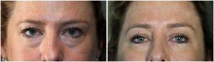 2 Syringes Of Juvederm Ultra XC To Vermillion Border And Lips By Dr. Lee B. Daniel, Plastic Surgeon In Eugene, Oregon (2)