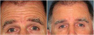 20 Units Of Botox To The Glabella And Lateral Brow By Patti Flint MD PC, MD, Scottsdale AZ Plastic Surgeon