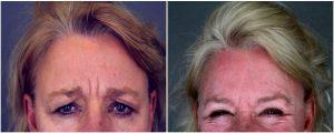 20 Units Placed To The Glabella By Patti Flint MD PC, MD, Scottsdale AZ Plastic Surgeon