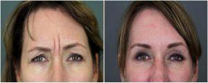 20 Units To The Frown Lines By Patti Flint MD PC, MD, Scottsdale AZ Plastic Surgeon