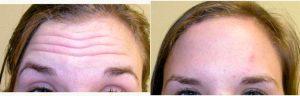 20 Year Old Woman Treated With Botox By Dr. Jeff Angobaldo, MD, Dallas Plastic Surgeon