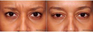 21 Year Old Woman Treated With Botox And Restylane With Doctor Stephen Weber, MD, FACS, Denver Facial Plastic Surgeon