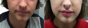 22 Year Old Man Treated With Restylane Before & After By Dr. Justin Harper, MD, Columbus Physician