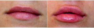 22 Year Old Woman Treated With Juvederm Before & After With Dr Richard G. Reish, MD, FACS, New York Plastic Surgeon