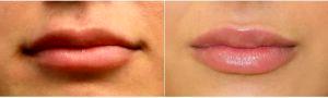 22 Year Old Woman Treated With Juvederm By Dr Richard G. Reish, MD, FACS, New York Plastic Surgeon