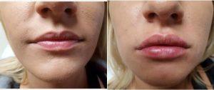 23 Year Old Woman Treated With Juvederm By Dr Olga Zilberstein, MD, Brooklyn Physician