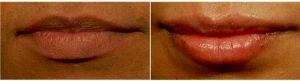 23 Year Old Woman Treated With Restylane Before & After With Dr. Katherine A. Orlick, MD, Tucson Dermatologist