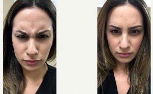 24 Year Old Woman Treated With Botox With Dr Donna Tran, DO, Webster Physician