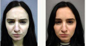 24 Year Old Woman Treated With Botox for A Furrowed Brows By Dr. Spencer Berry, MD, Fargo Family Physician