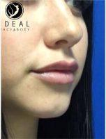 24 Year Old Woman Treated With Juvederm By Doctor Justin Yovino, MD, FACS, Beverly Hills Plastic Surgeon