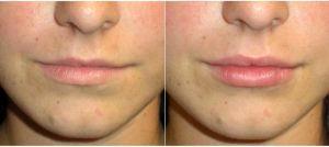 24 Year Old Woman Treated With Restylane By Dr Jeff Angobaldo, MD, Dallas Plastic Surgeon