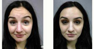 24yr Old Woman Treated With Botox With Doctor Spencer Berry, MD, Fargo Family Physician